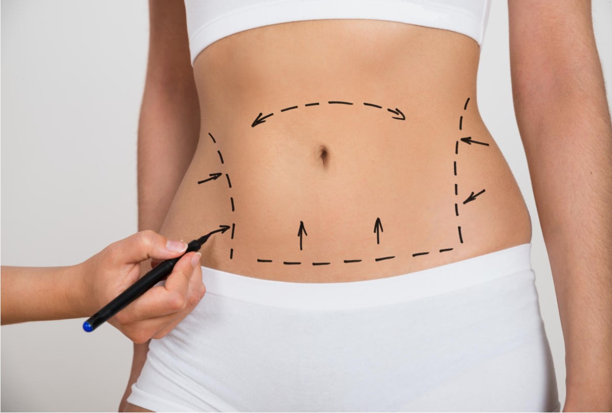 Understanding Tummy Tuck Scars: Riyadh Experts Explain