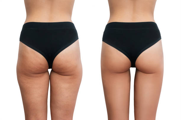 Smooth Thighs Made Easy: Non-Surgical Thigh Lift in Riyadh