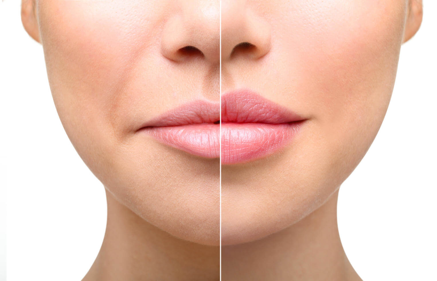 How to Fix Uneven Lips with Lip Augmentation in Islamabad