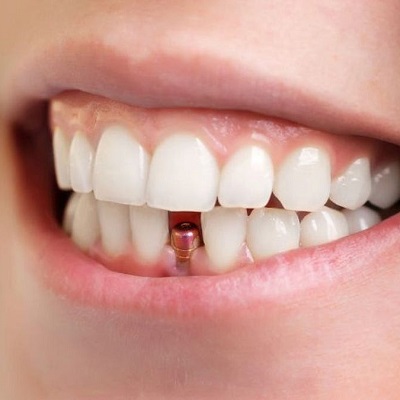 How Same-Day Dental Implants Can Change Your Life in Hours