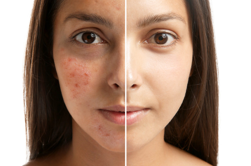 How Acne Treatment Can Help Smooth Rough Skin