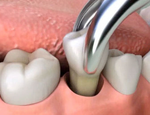 How to Make Tooth Extraction Less Stressful