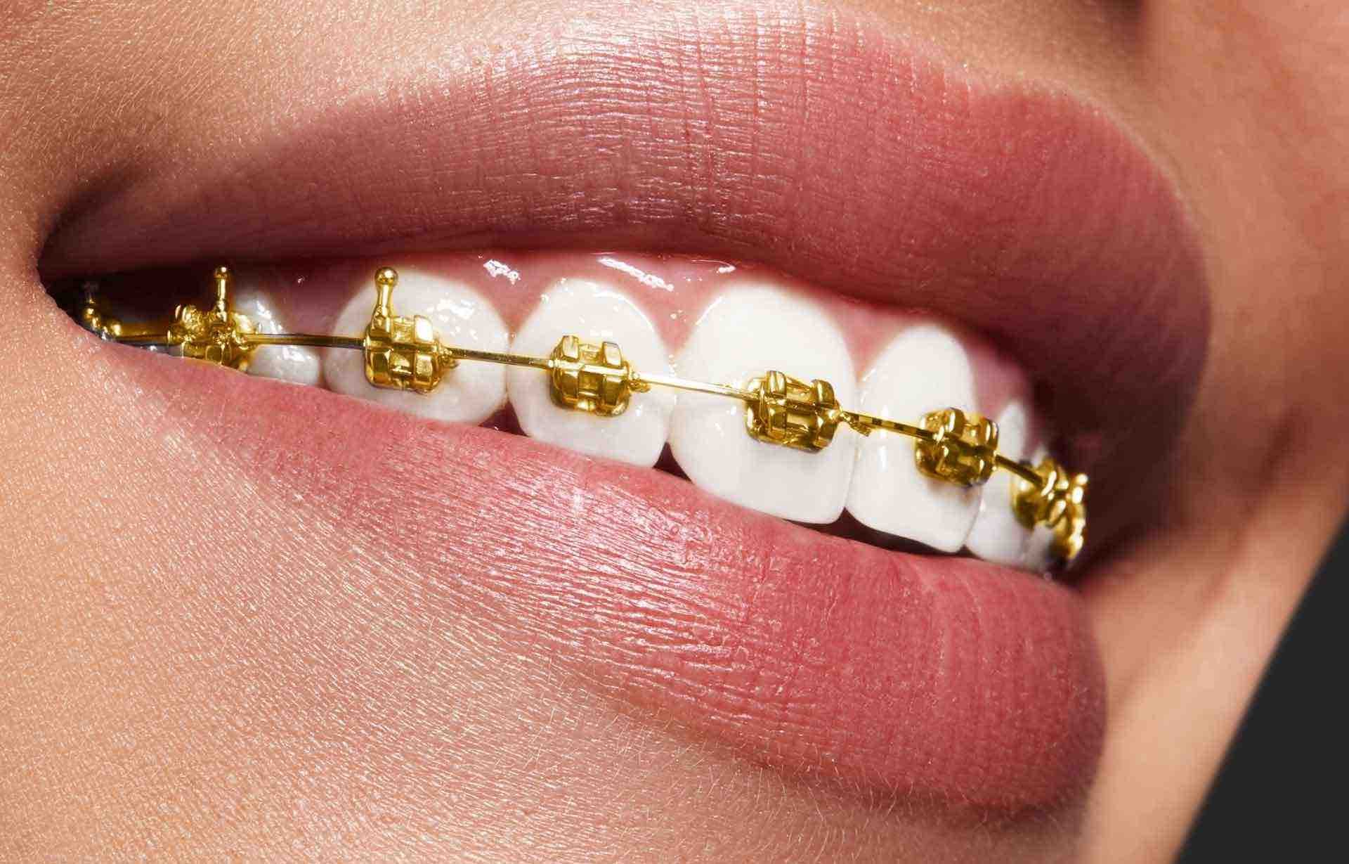 Adult Braces: Why It's Never Too Late to Get Dental Braces