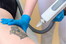 Can PicoSure Remove All Colors of Tattoos?