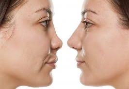 Closed Nose Job: A Comprehensive Guide to the Minimally Invasive Rhinoplasty
