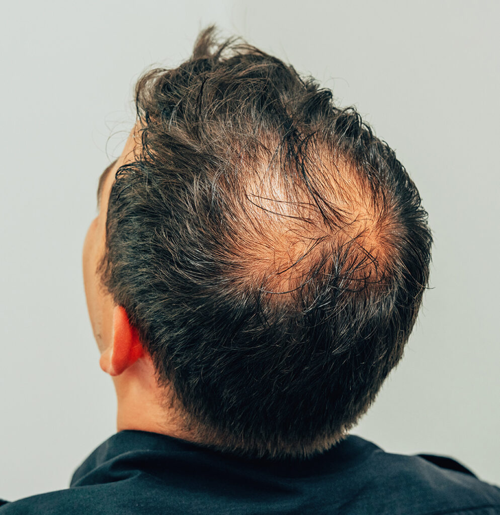 How Finasteride for Hair Loss Helps You Maintain a Full Head of Hair