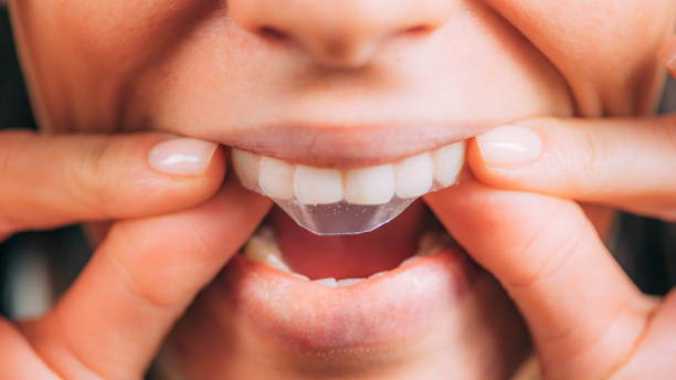 Get Professional Results with Teeth Whitening Strips in Riyadh
