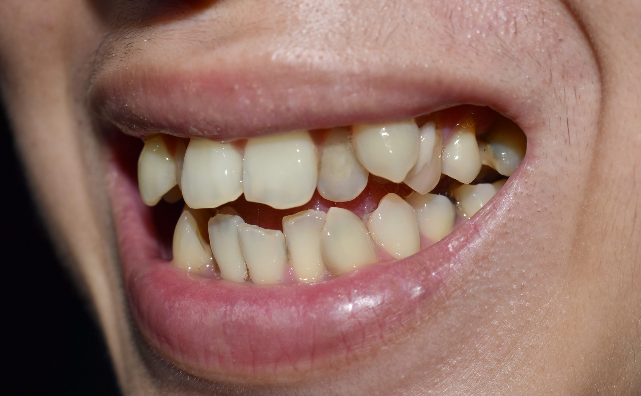 The Journey to Straighten Overlapping Teeth