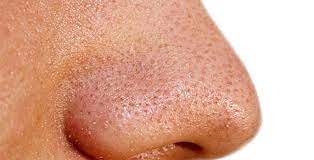 An Overview of Treatment Costs for Large Pores Solutions