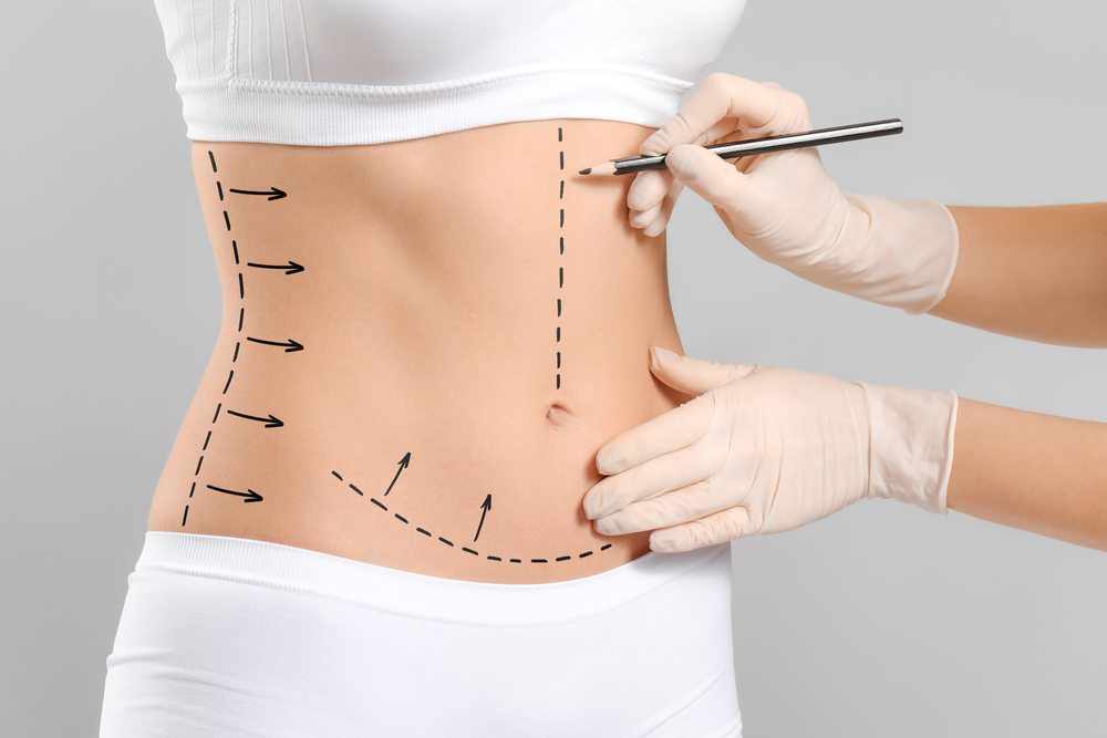 What to Expect During Your Tummy Tuck Consultation Process