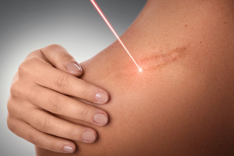 Stretch Marks Treatment Market to Reach USD 4.95 Billion by 2033, Driven by 5,2% CAGR