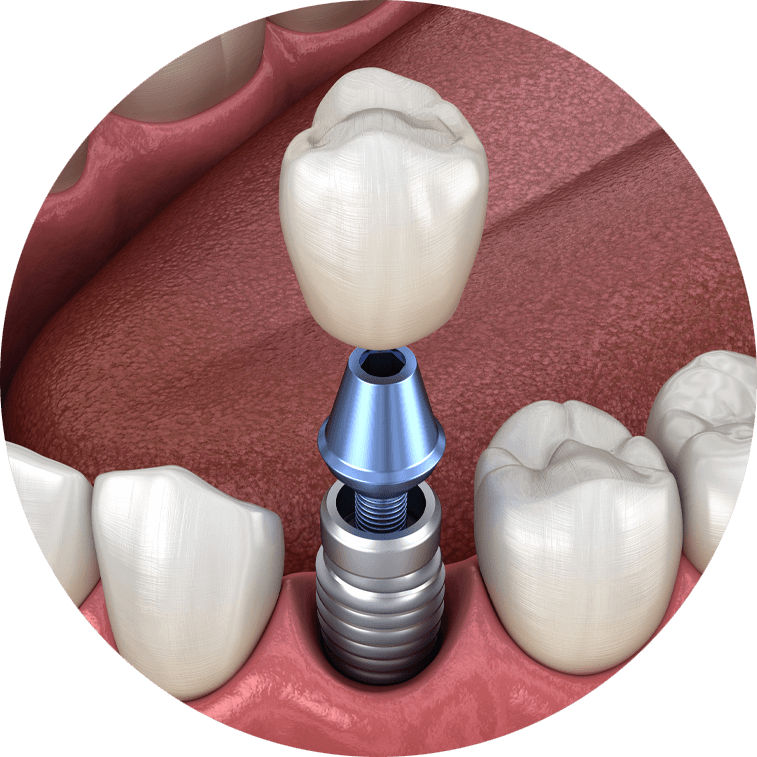 The Science Behind Dental Implants