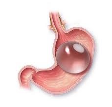 Navigating Your Gastric Balloon Journey: Tips for Better Results