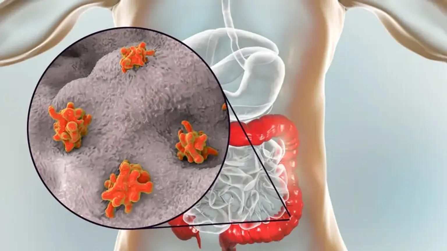 Food Safety Tips to Avoid Amebiasis Infection