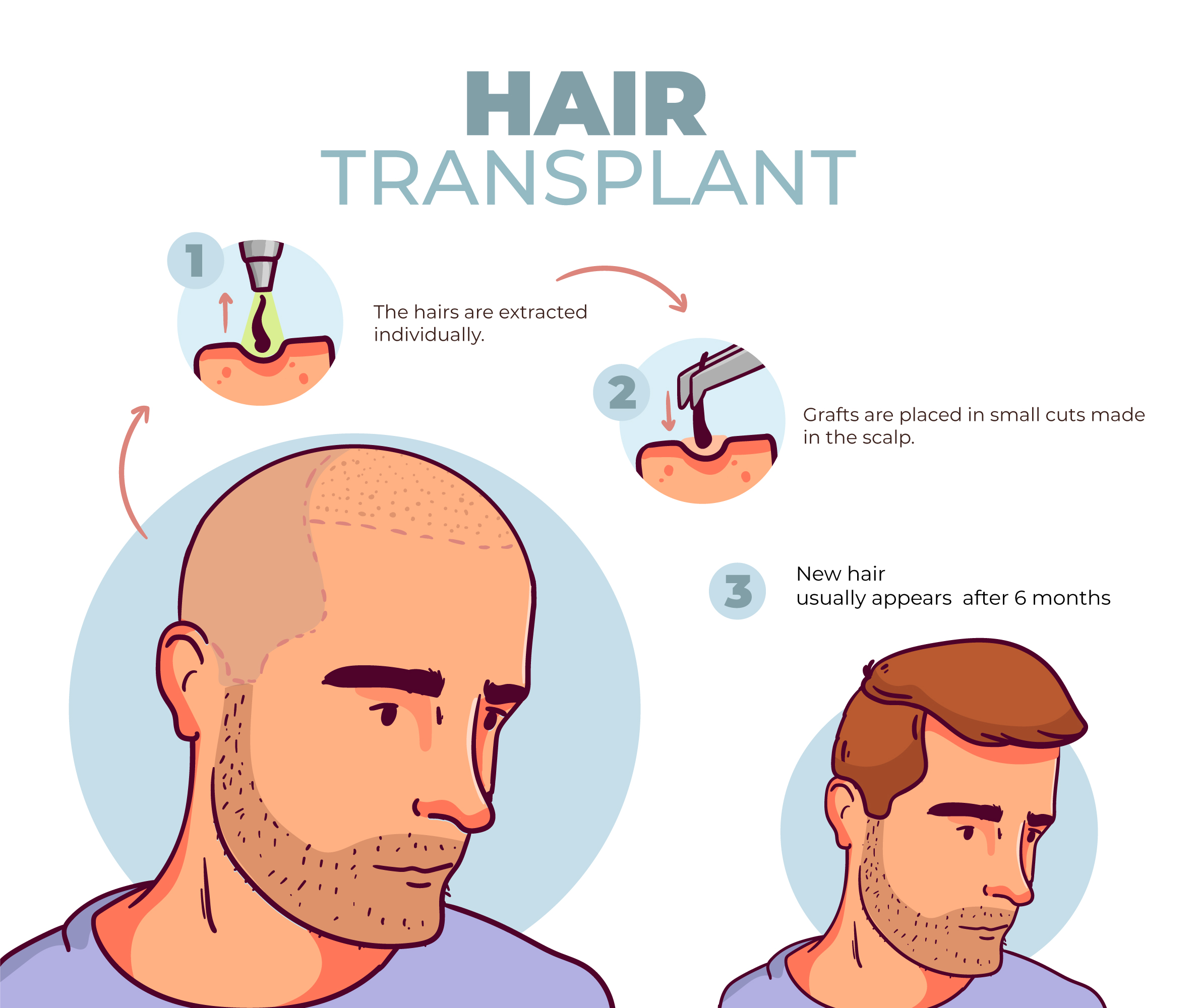 Understanding the FUE Hair Transplant Procedure