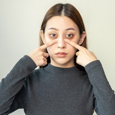 All You Need to Know About Dark Circles Removal in Islamabad