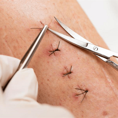 Suture Removal Without a Doctor, How to Do It Right