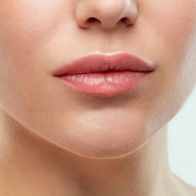 Before and After: Lip Augmentation Transformations in Muscat