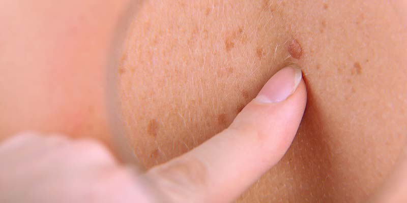 How Skin Tag Removal Can Help Restore Youthful Skin Appearance