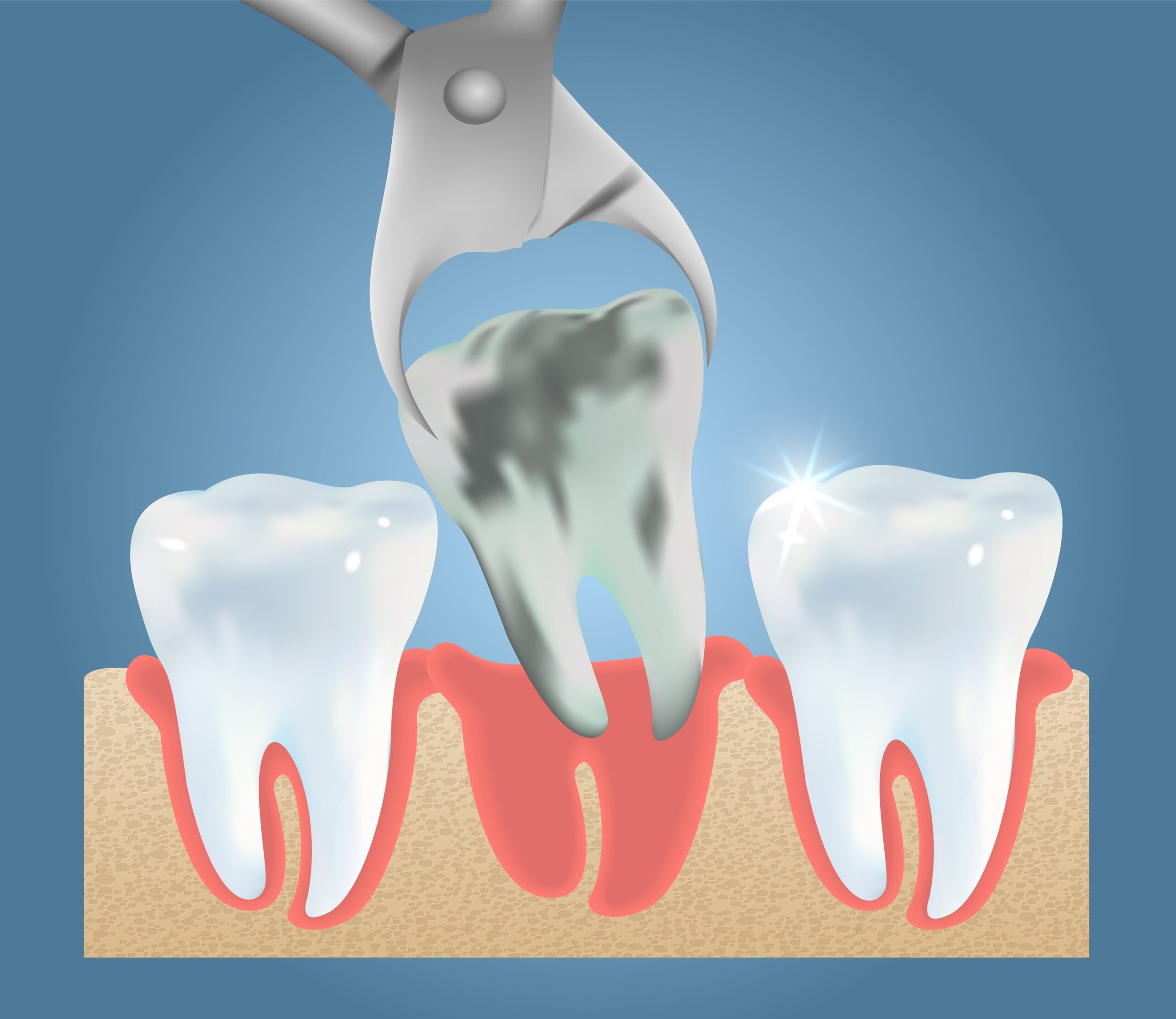 When Is Tooth Extraction the Only Option?