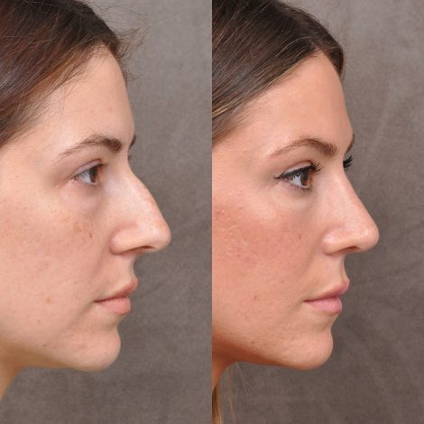 Rhinoplasty Cost in Los Angeles: What You Need to Know