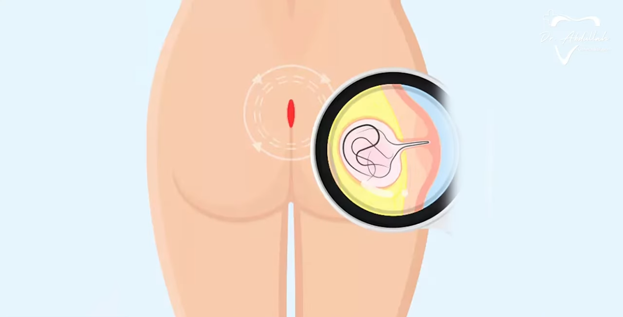 Understanding Pilonidal Sinus: Symptoms and Treatment Options