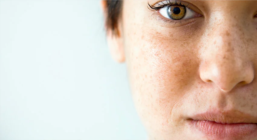 The Latest Innovations in Pigmentation Treatments in Islamabad