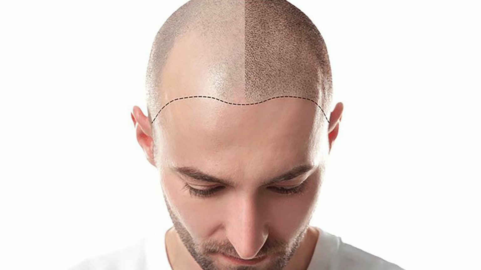 Hair Transplant Success Stories from Riyadh