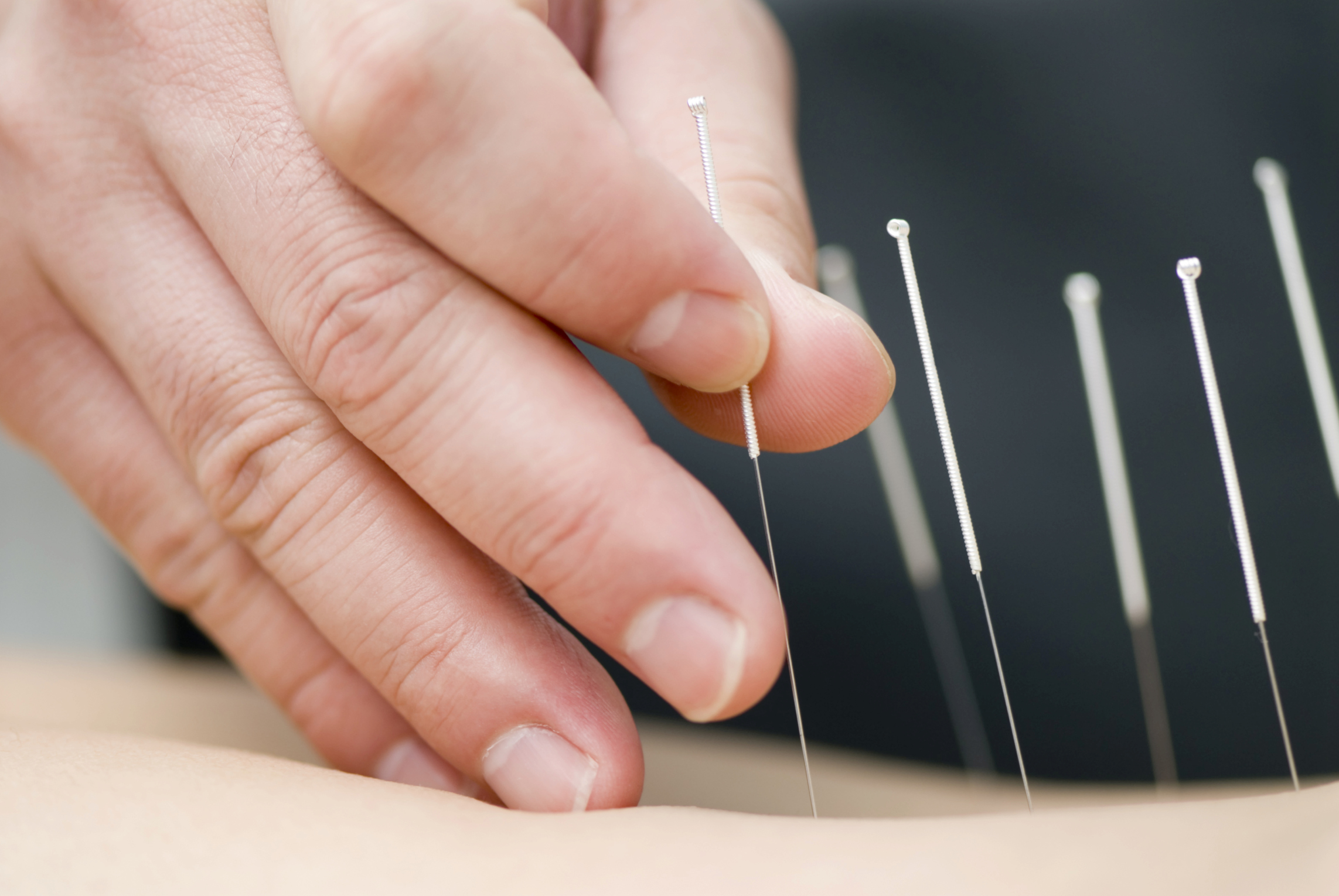 Can Acupuncture Be Your Solution for Weight Loss?