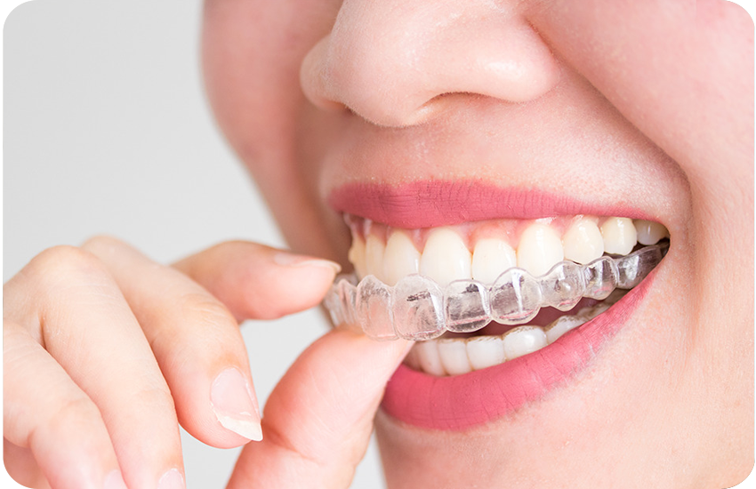 Straightening Smiles: How Dental Braces Can Transform Your Teeth