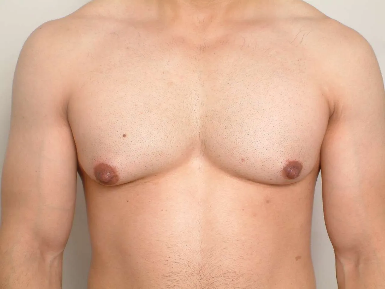 Is Gynecomastia Affecting Your Fitness Goals?