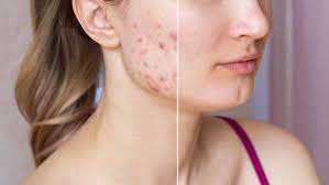 Acne Management Guide: Strategies for All Severity Levels
