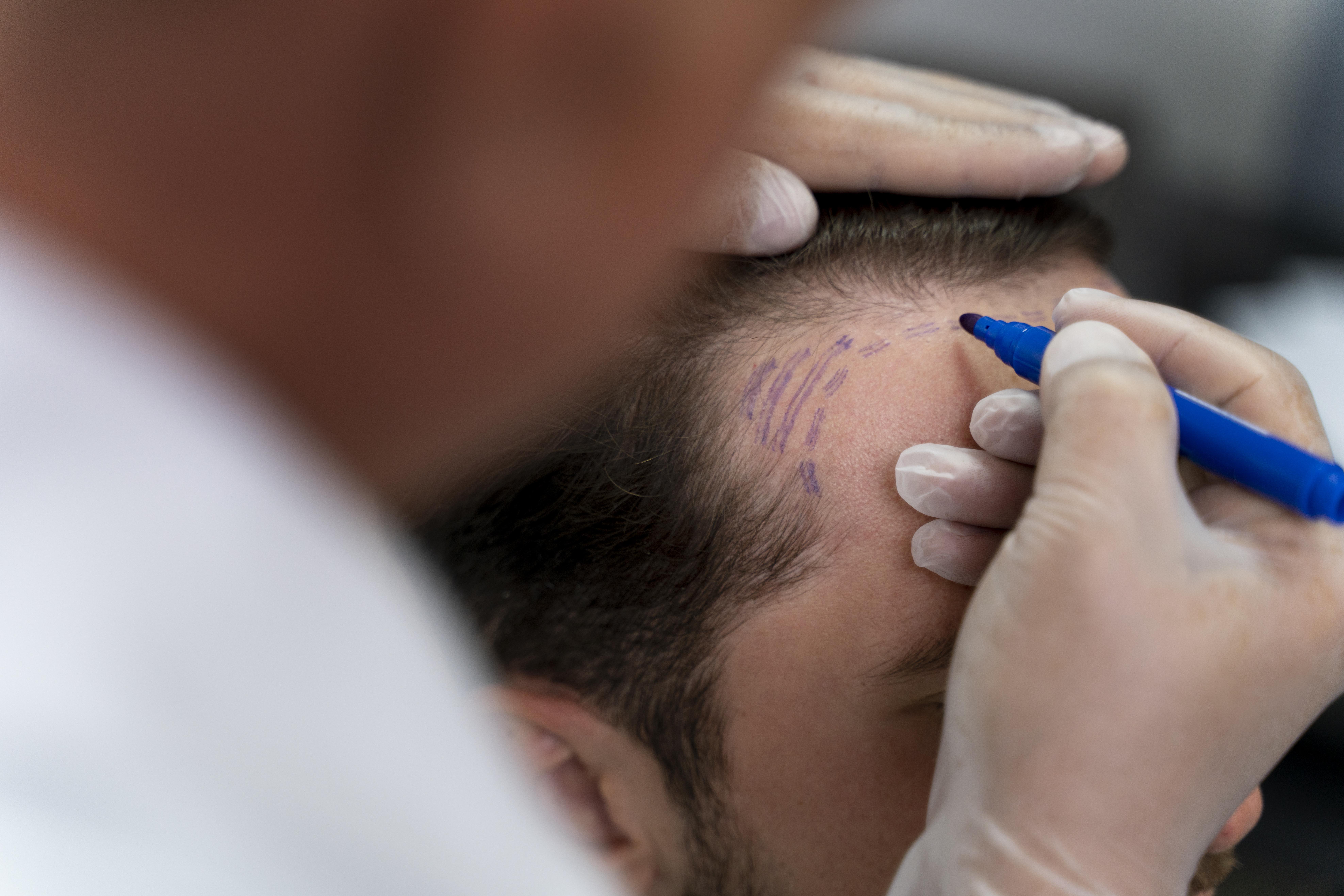 10 Things You Didn't Know About Hair Transplants in Gurgaon, Noida, and Lucknow