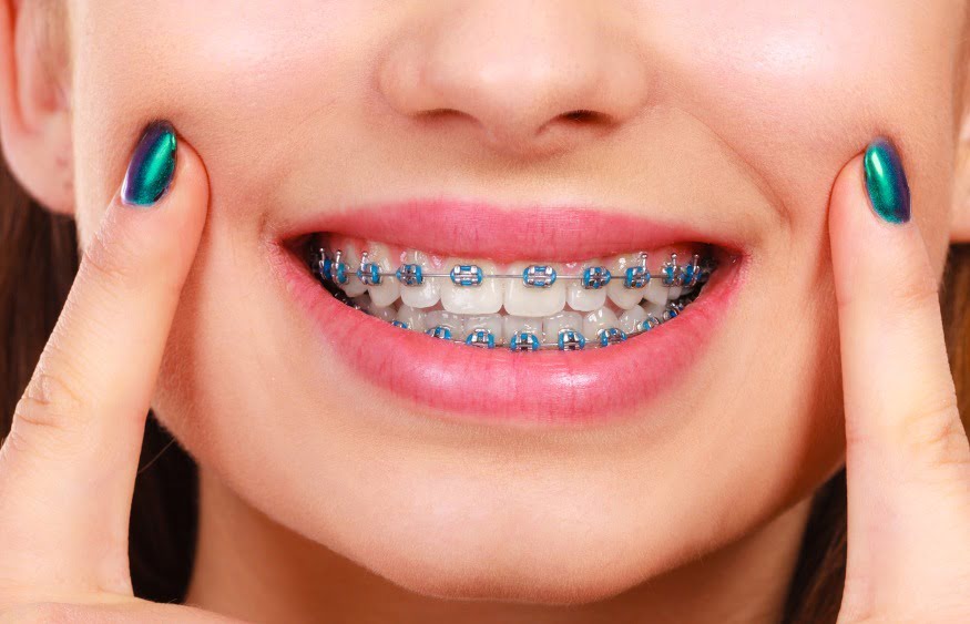 Maintaining Your Braces: Essential Tips for a Smooth Experience