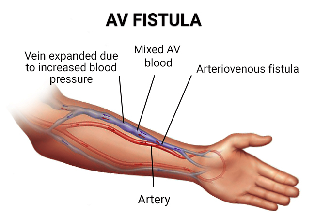 Best Fistula Surgery in Riyadh for Fast Recovery