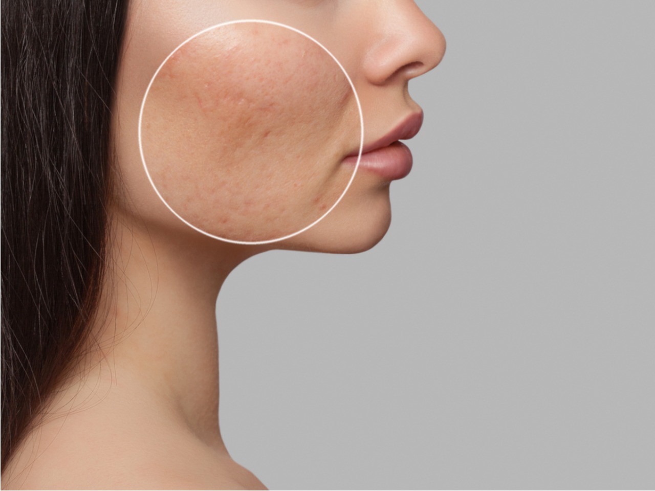 Do people notice acne scars?