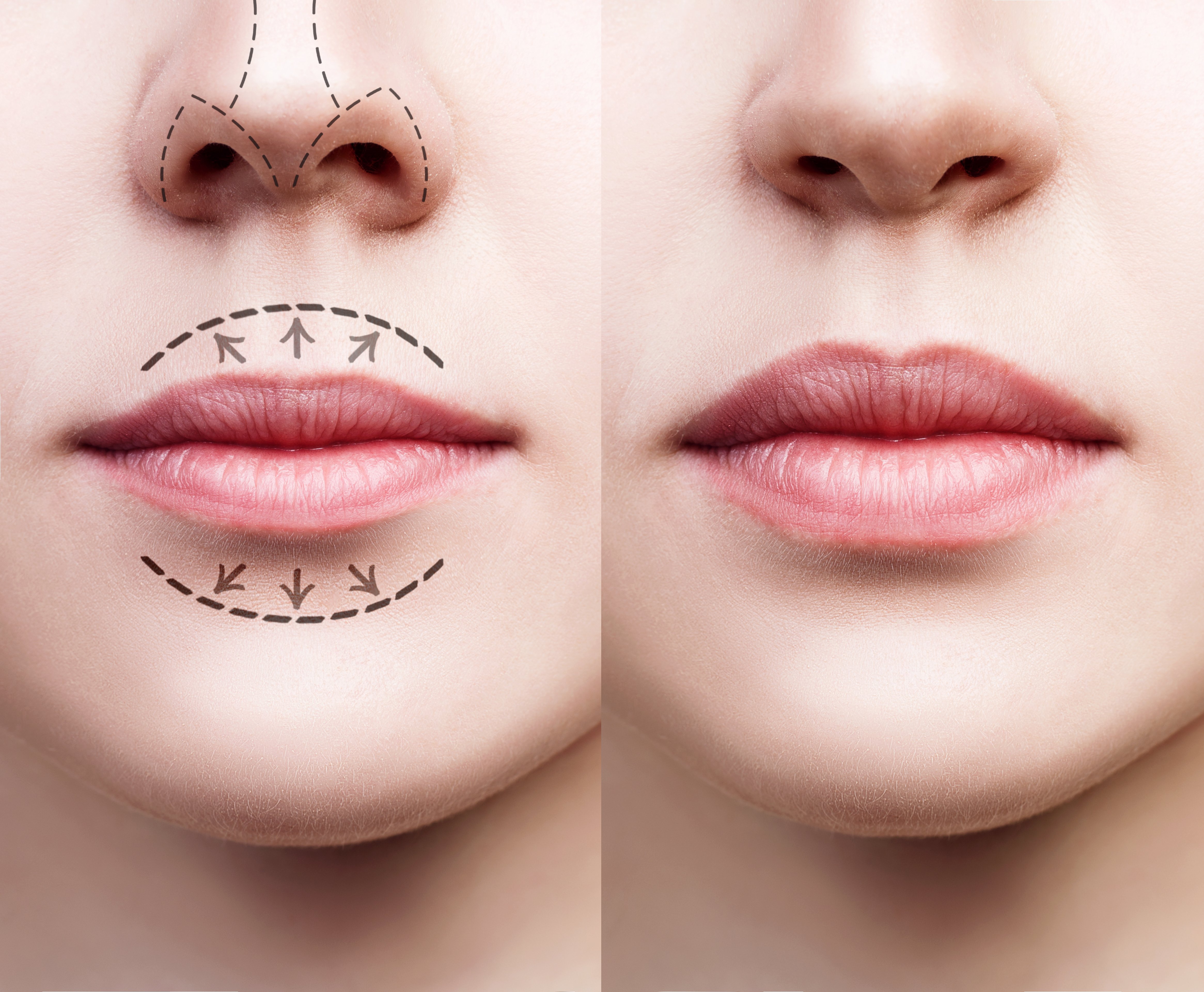 The Art of Perfecting Your Lips with Fillers