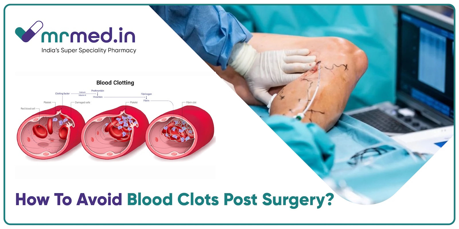 Effective Strategies to Avoid Blood Clots After Abdominal Procedures