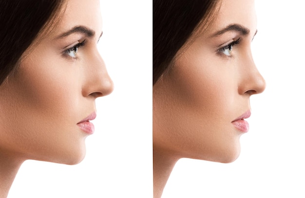 Is Rhinoplasty a Solution for Chronic Sinus Issues?