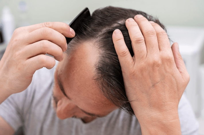 Exosomes for Hair Loss in Dubai: The Future of Hair Restoration