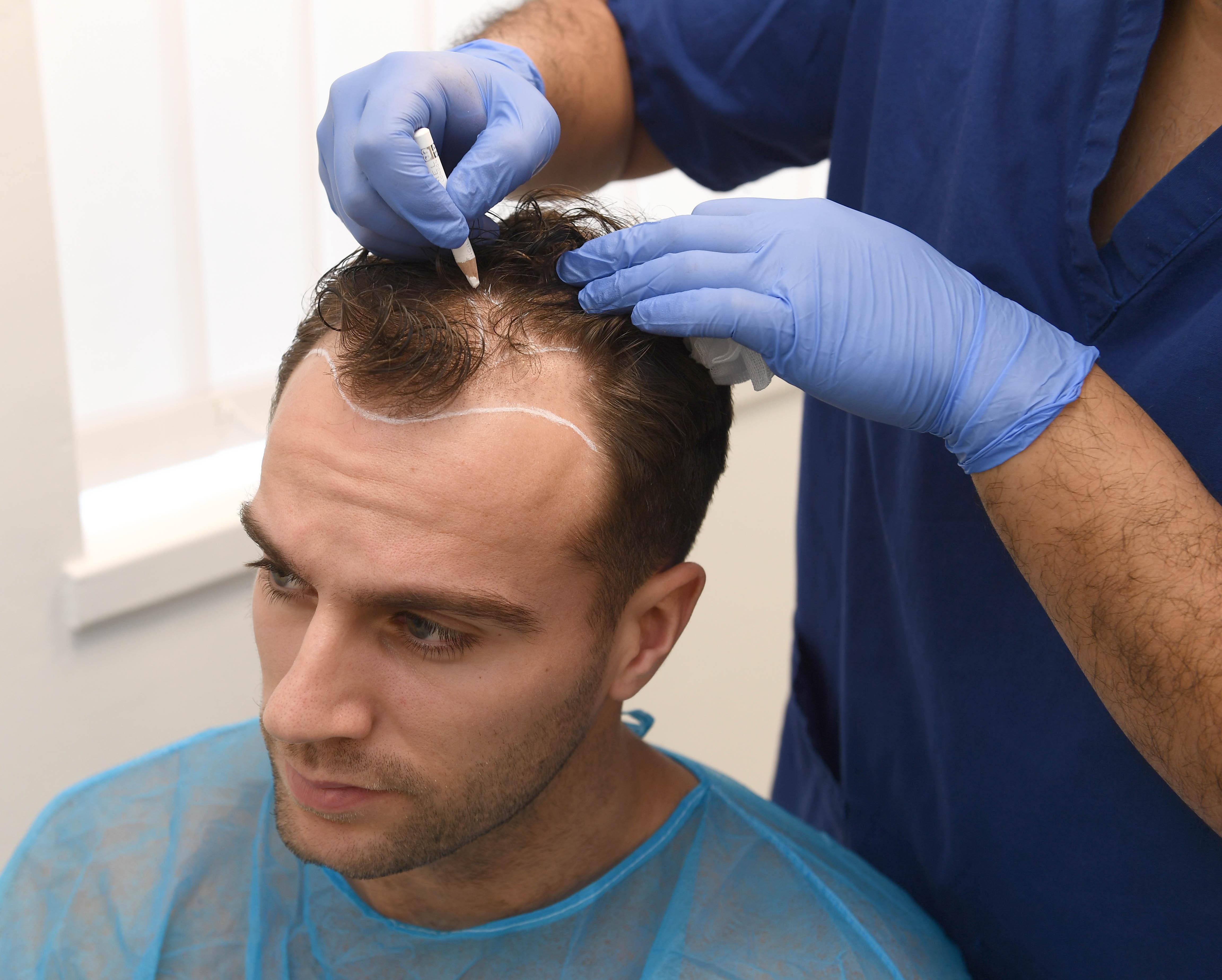 Why Hair Transplant Is Popular In 2025