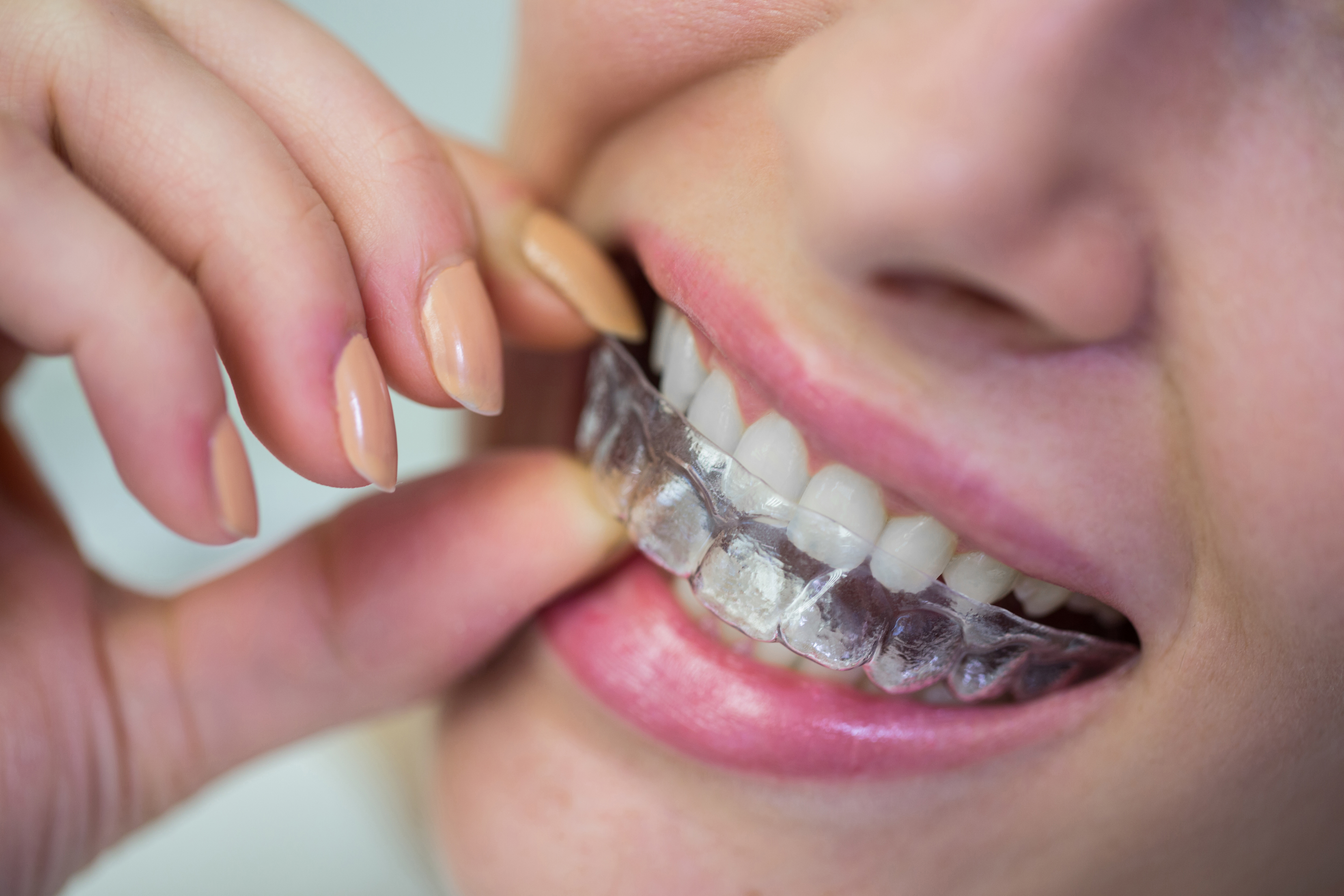 Clear Alignment: Having an Expert Treatment for the Perfect Smile
