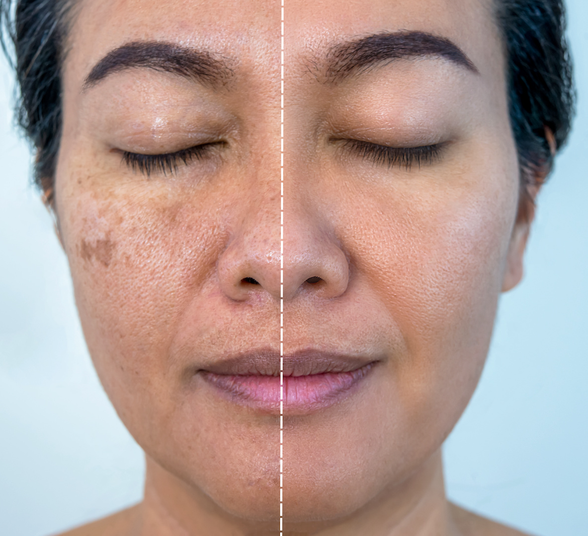 Melasma Treatment Cost in Dubai: What to Expect and How to Plan