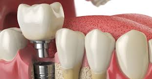 The Mini Dental Implants vs. Single Tooth Implants: Which is Right for You?