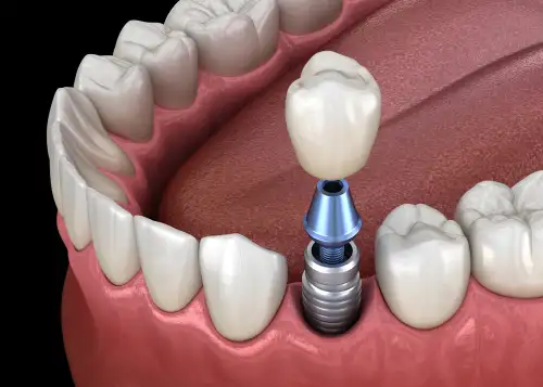 The Top Myths and Facts About Dental Implants in Dubai You Should Know