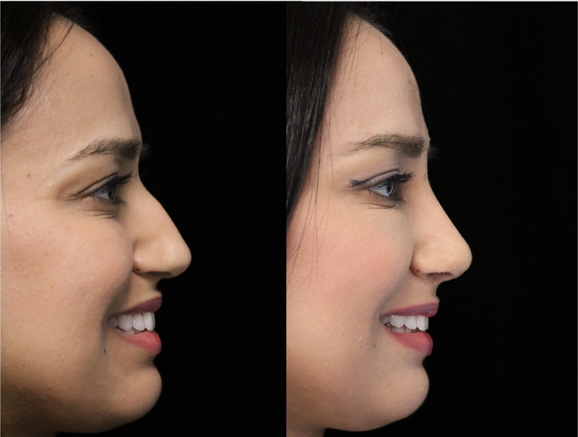 What You Should Know About a Bulbous Nose Job