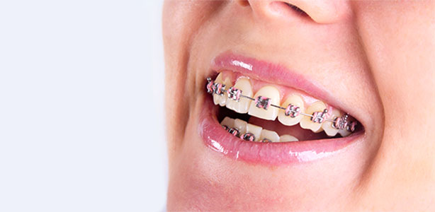 From Crooked to Perfect, Braces Explained