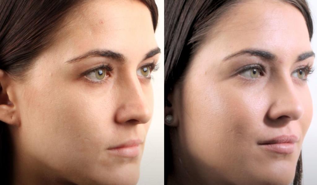 Cheek Filler Injection in Riyadh – Quick & Painless Procedure