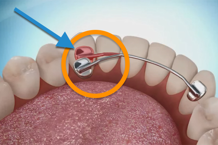 What to Expect When Wearing a Retainer
