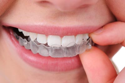 Top 5 Hidden Dangers of Clear Aligners You Should Know!